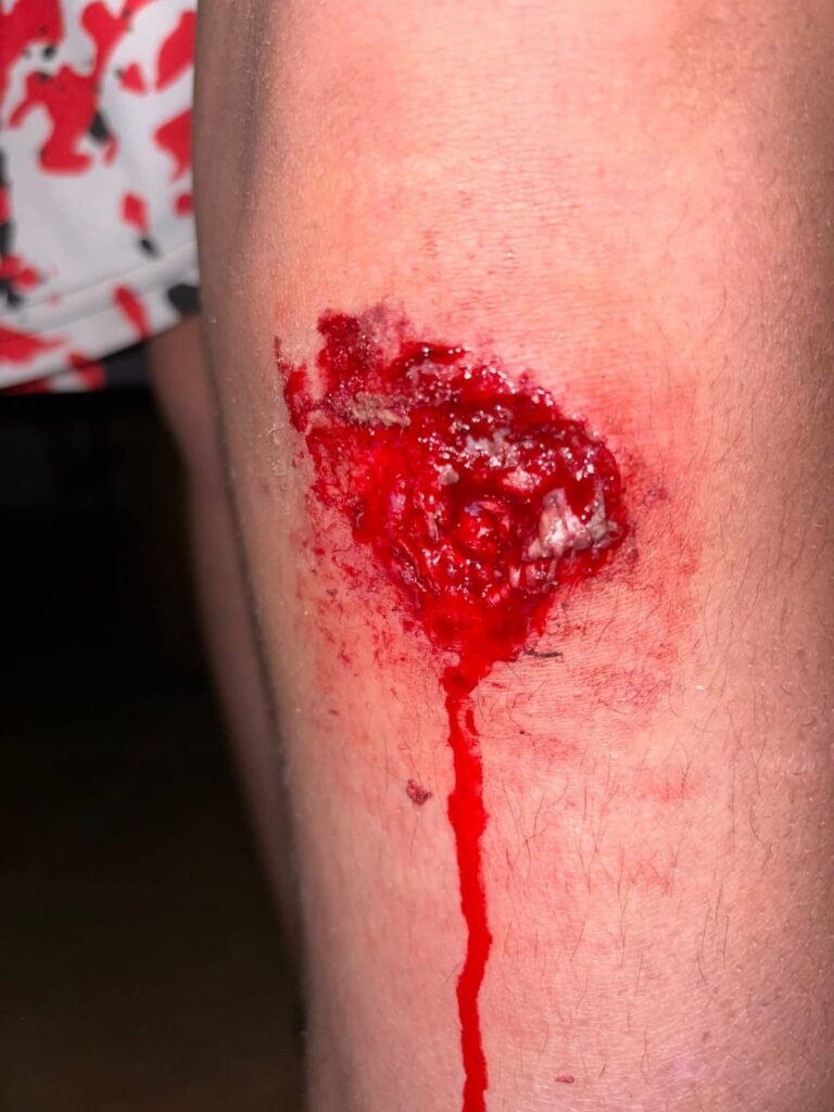 imagen sinsible herido